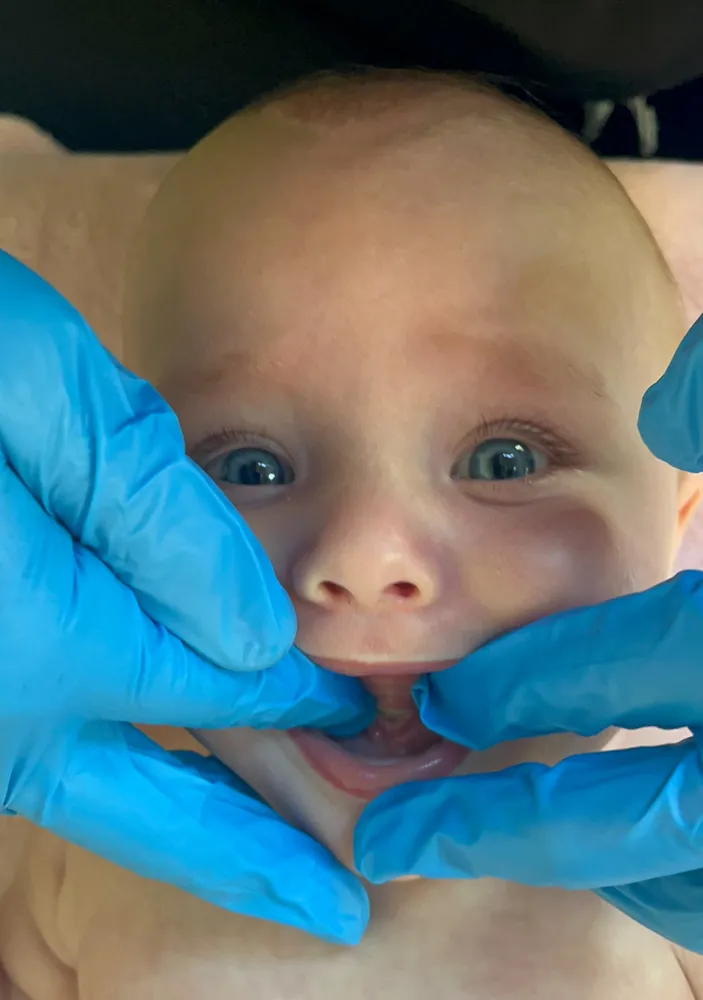 Therapist performing a gentle oral assessment on an infant